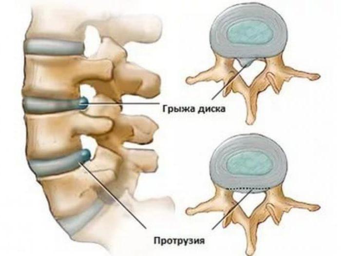 протрузия межпозвонкового диска l4 l5
