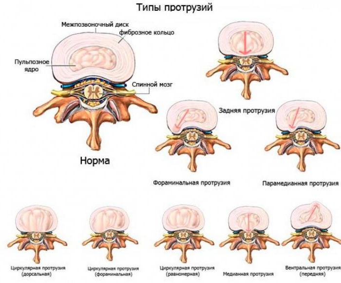 фиброзное кольцо межпозвонкового диска 