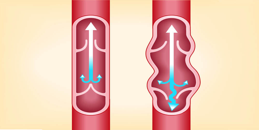 варикозное расширение