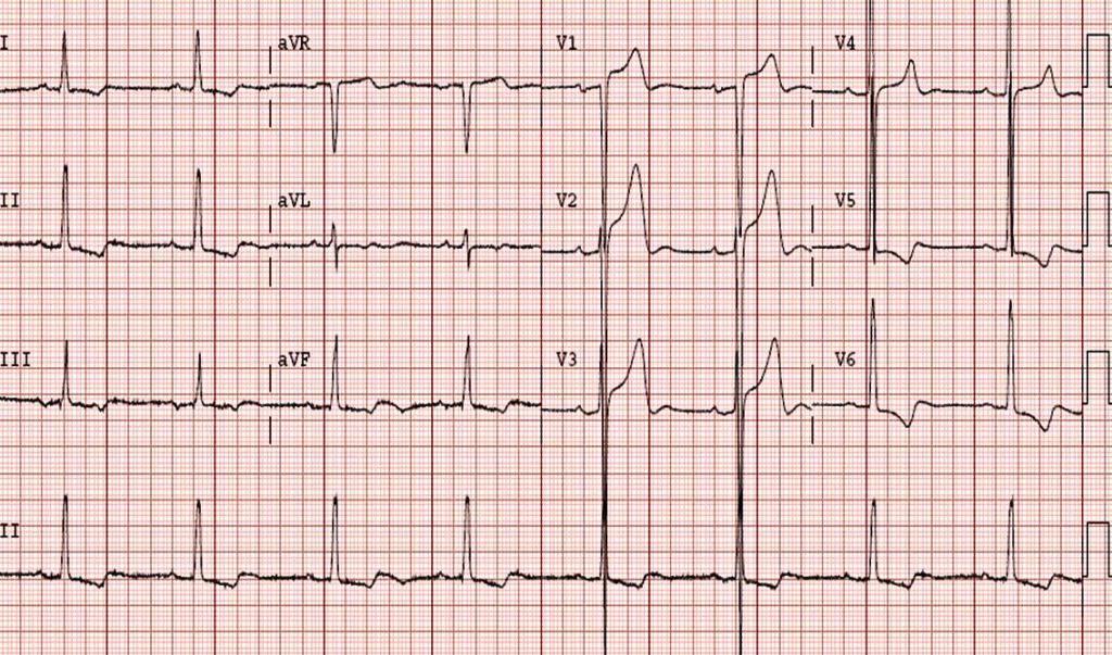Гипертрофия левого желудочка на ЭКГ