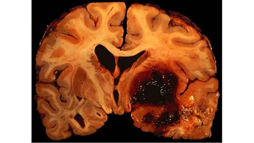 Кровоизлияние в мозг