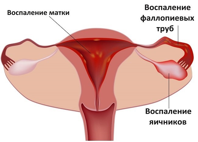 симптомы аднексита