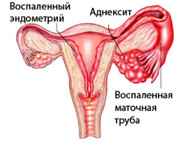 воспаление придатков