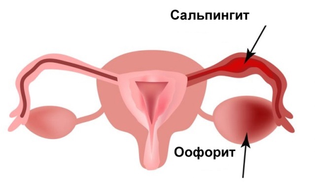 сальпингит оофорит