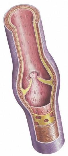Как лечить варикоз на ногах