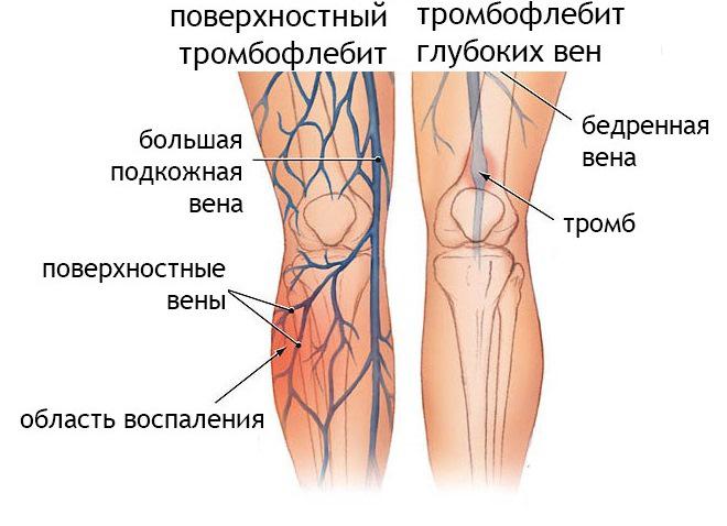 симптомы Хоманса и Мозеса отрицательные