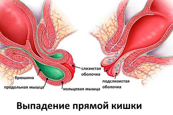 ректальный пролапс