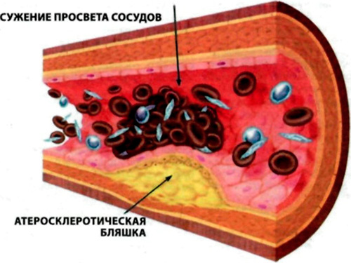 Холестериновая бляшка