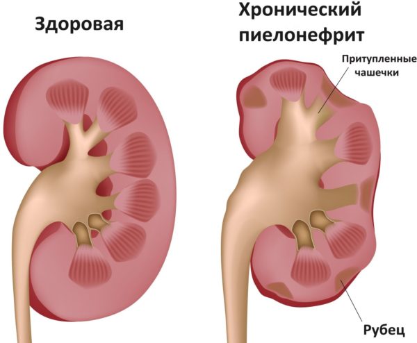 хронический пиелонефрит