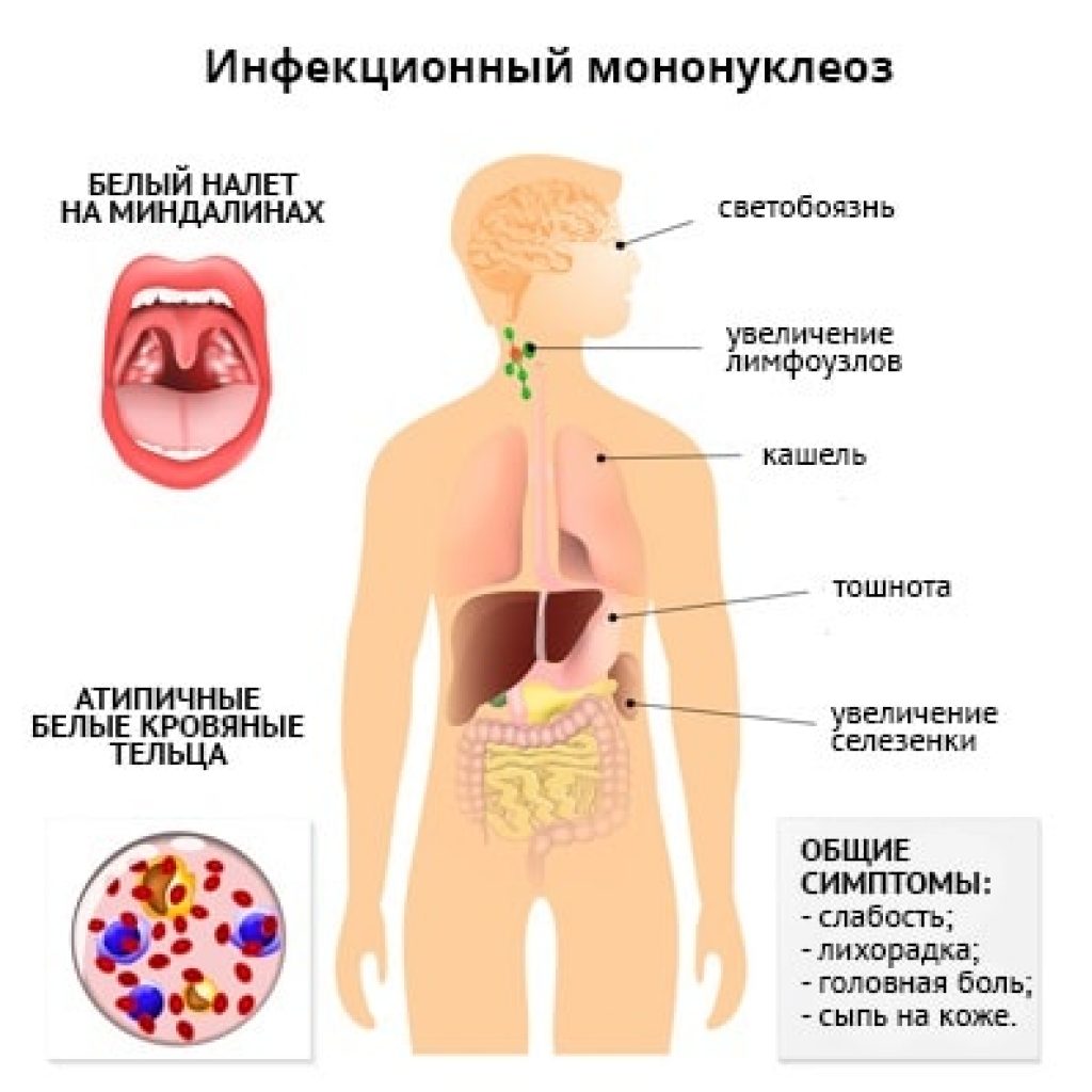 описание мононуклеоза