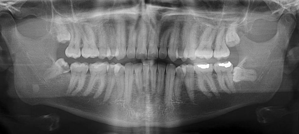 аномальное расположение зуба мудрости в челюсти