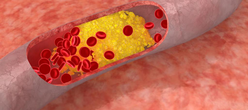 Артерии, забитые холестерином