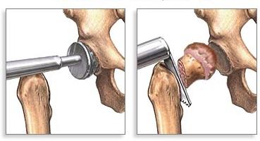 операция по замене тазобедренного сустава