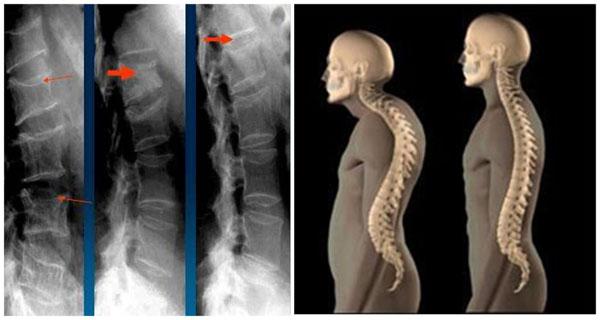 сколиоз грудного отдела позвоночника симптомы
