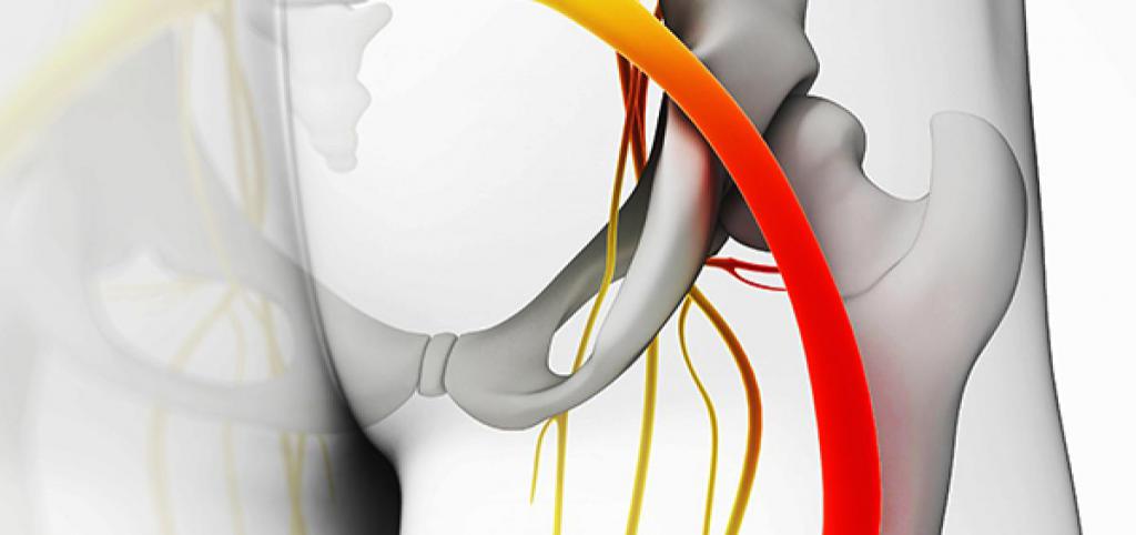 ишиалгия лечение в домашних
