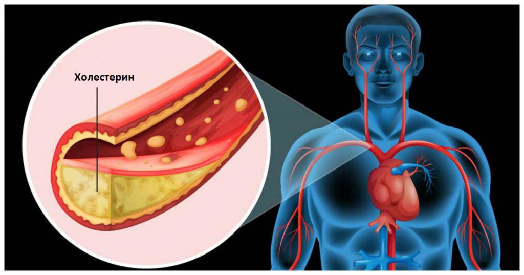 повышенный холестерин у мужчин лечение