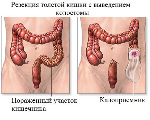 Резекция толстой кишки с выведением колостомы