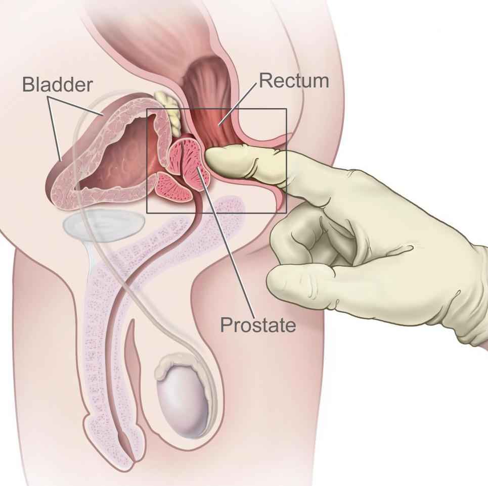 Массаж простаты