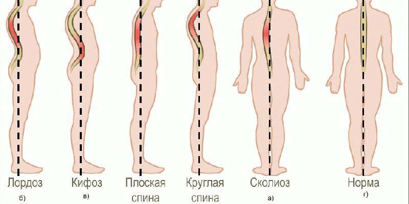 Как выглядит плоская спина?