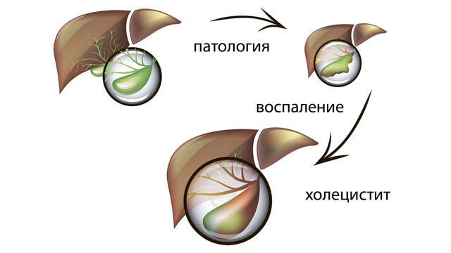 Развитие холецистита